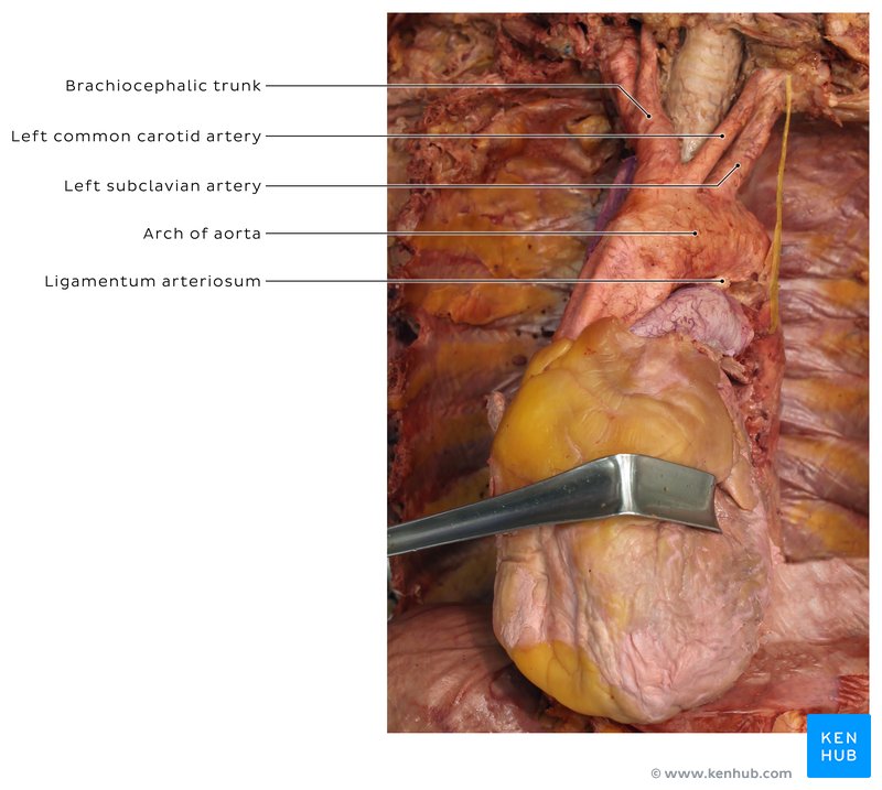 Heart, its great vessels and ligamentum arteriosum in a cadaver