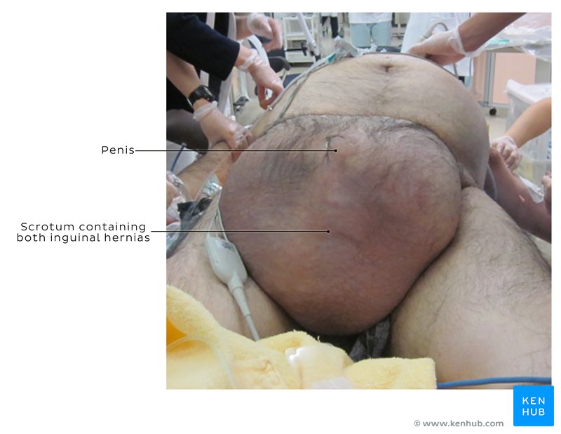 A case of a giant inguinal hernia: Anatomy and images
