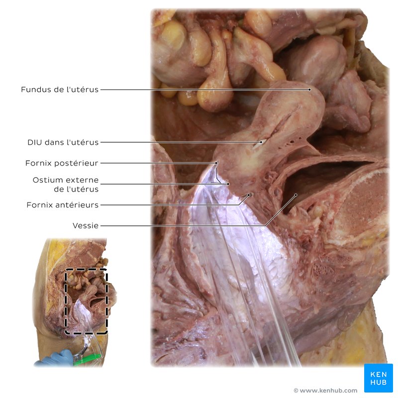 Utérus in situ dans un cadavre